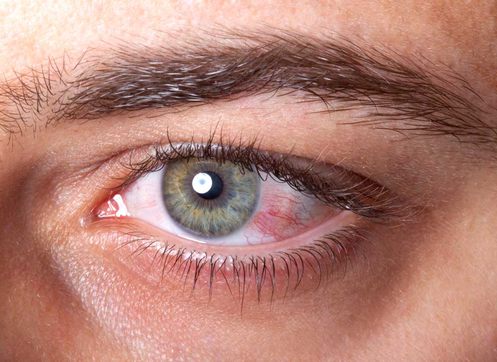 Bild Bindehautentzündung Auge