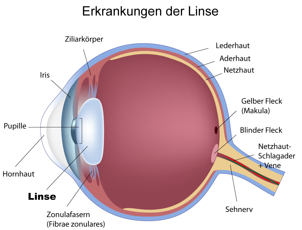 Bild Erkrankungen Linse Auge